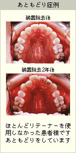 あともどり症例の写真：ほとんどリテーナーを使用しなかった患者様のあともどりをしてしまった口(装置除去2年後)